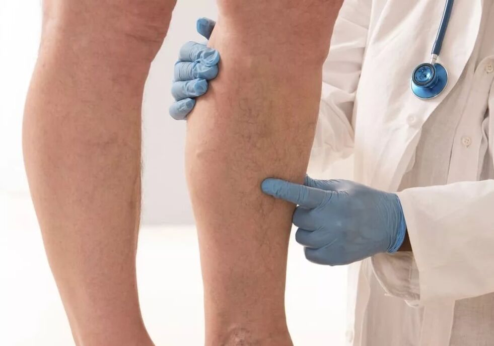 doctor examines legs with varicose veins