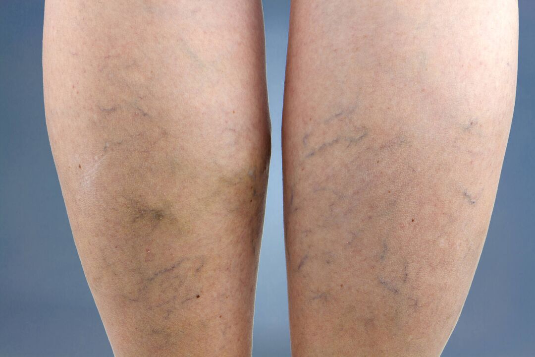 varicose veins in the legs