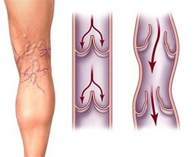 Normal operation of valves in a healthy vein and pathology of valves in a varicose vein