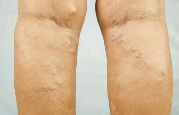 Varicose veins in the legs are a reason to consult a phlebologist