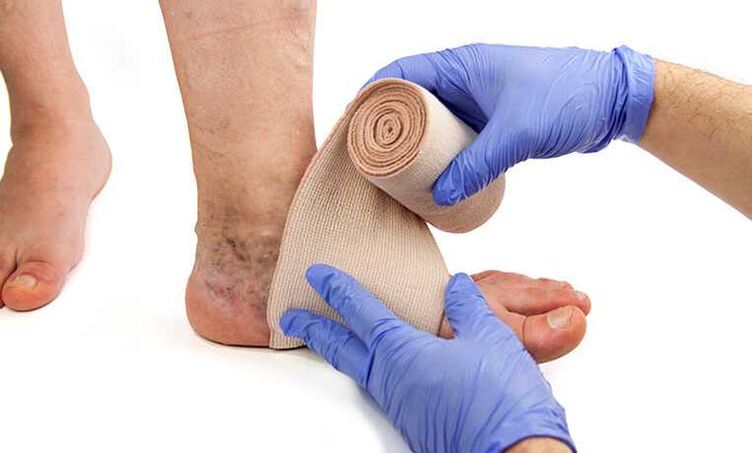 Treatment of varicose veins on the legs is complemented by the use of compression hosiery