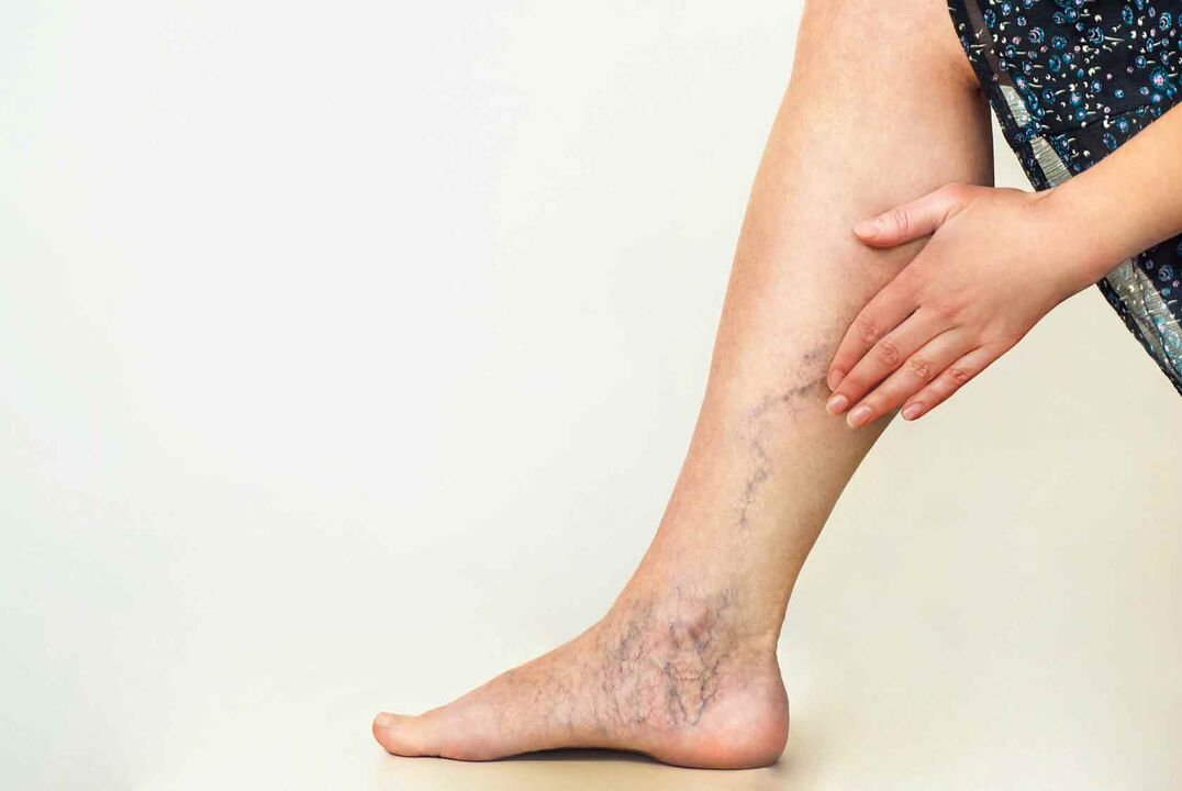 varicose veins on the legs of women