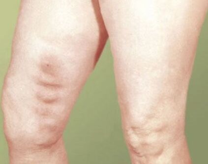 Phlebitis