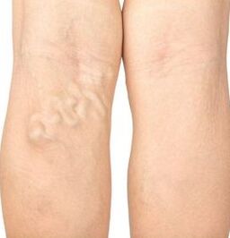 Symptoms of varicose veins