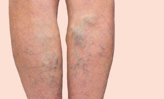 Varicose veins
