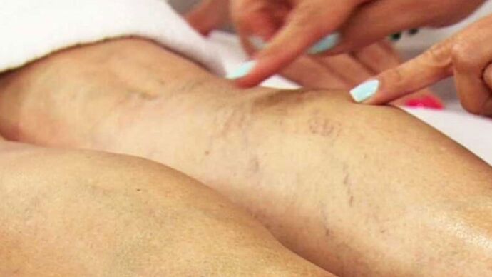 Varicose veins of the lower extremities