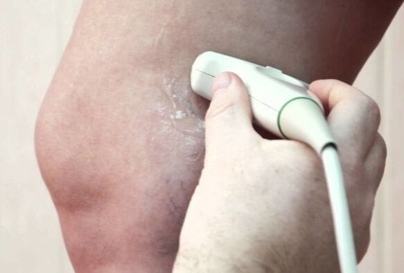 Diagnosis of varicose veins