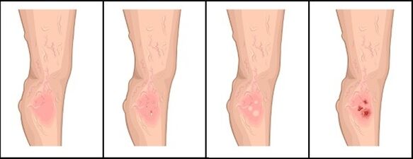 The degree of varicose veins