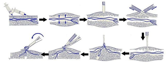 Varadi operation