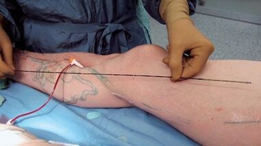 How is surgery performed for varicose veins