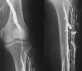 Diagnosis options for varicose veins of the extremities