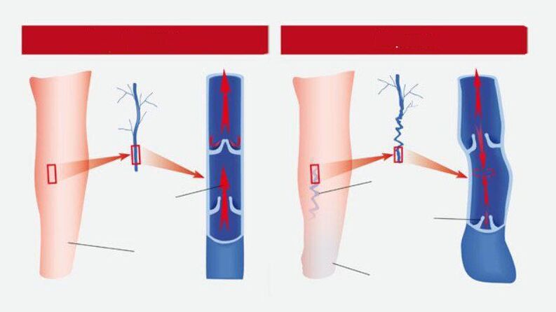 What varicose veins look like